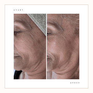 Avant / après drainage visage : poches réduites, teint lumineux