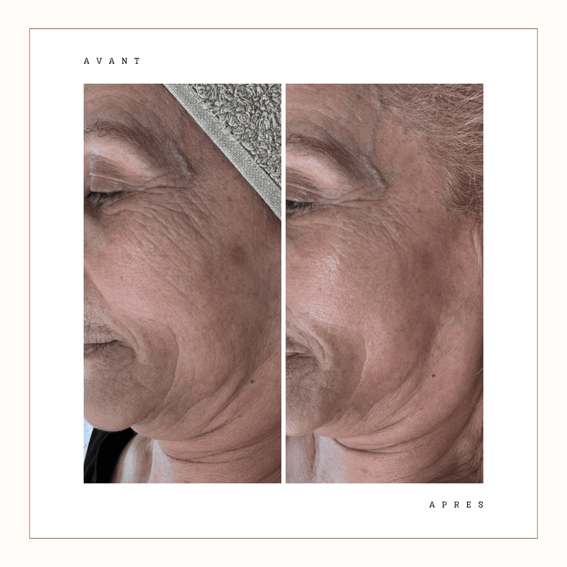 Avant / après drainage visage : poches réduites, teint lumineux