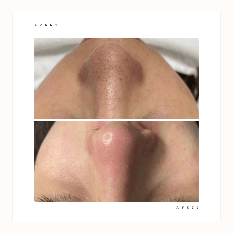 Avant après Aquapure visage — peau nettoyée, grain de peau affiné.